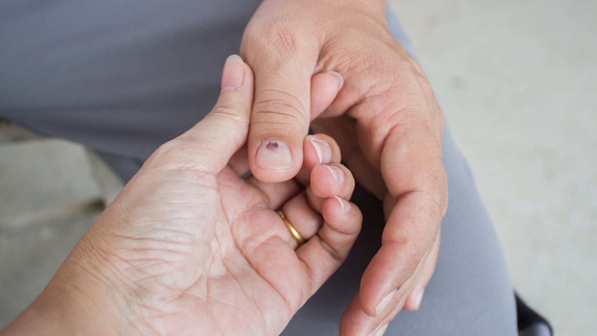 Las uñas amarillentas pueden ser señal de daño en el hígado y otros  problemas de salud  Estilo de Vida Bienestar  Univision